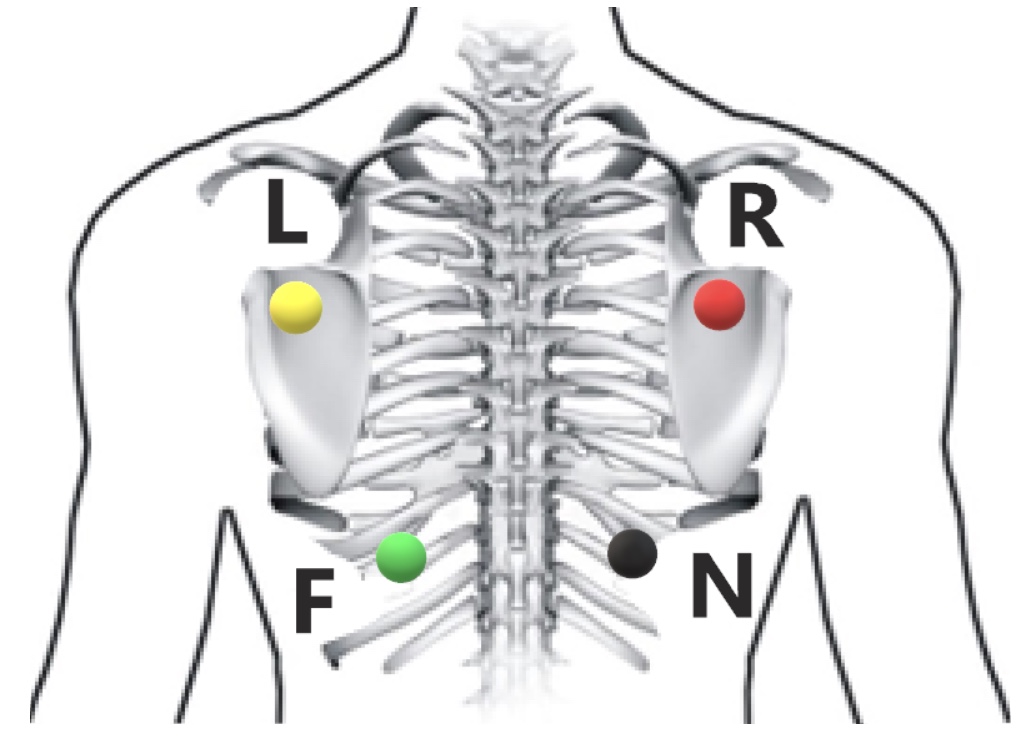 Схема наложения кабеля пациента на 12 грудных отведения 2