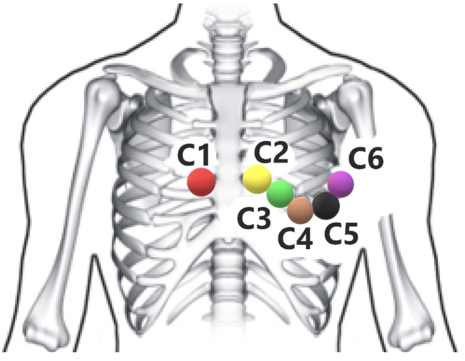 Схема наложения кабеля пациента на 12 грудных отведения 1